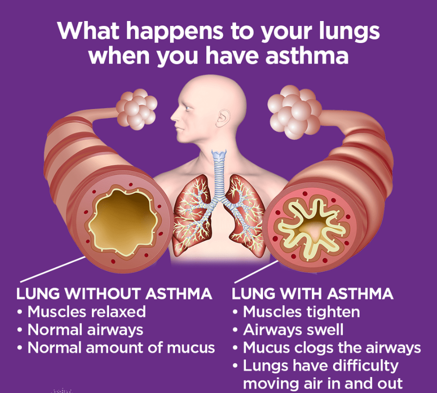What happens to your lungs when you have asthma